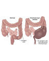 Hirschsprung &Anorectal malformation cover