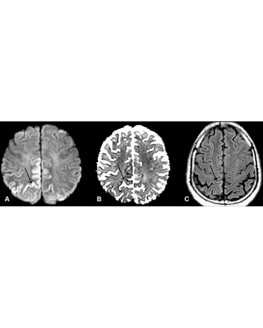 PRION DISEASES cover