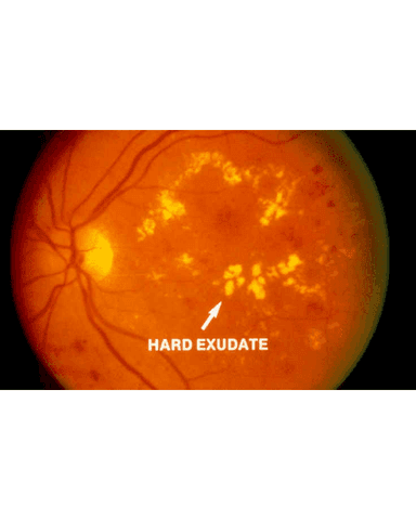 DIABETIC COMPLICATIONS cover