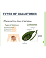 CHOLELITHIASIS, CHOLEDOCHOLITHIASIS, CHOLECYSTITIS AND CHOLANGITIS cover