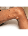 PEMPHIGUS VULGARIS PRIMARY BLISTERING DISEASES cover