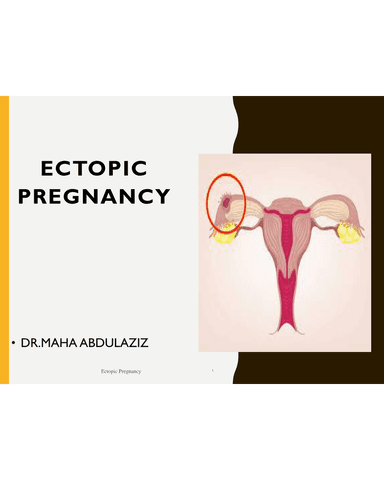 ECTOPIC PREGNANCY cover