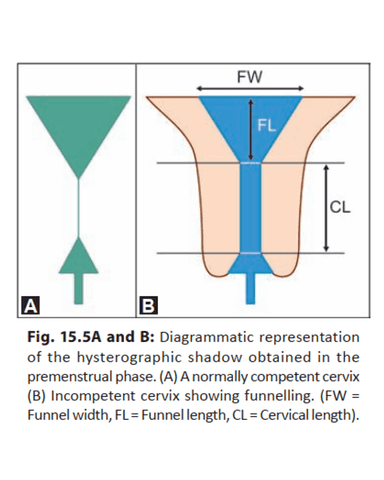 RECURRENT LOSS OF PREGNANCY AND IUFD cover